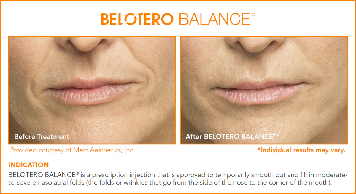 Belotero Before and After Photos