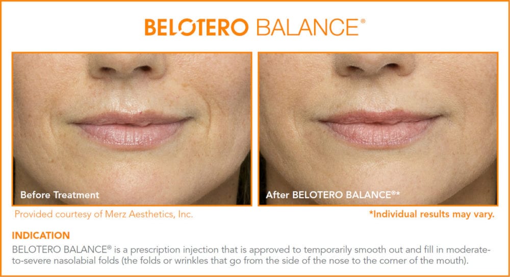 Belotero Before and After Photos
