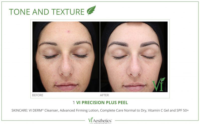 Chemical Peels Before and After Photos