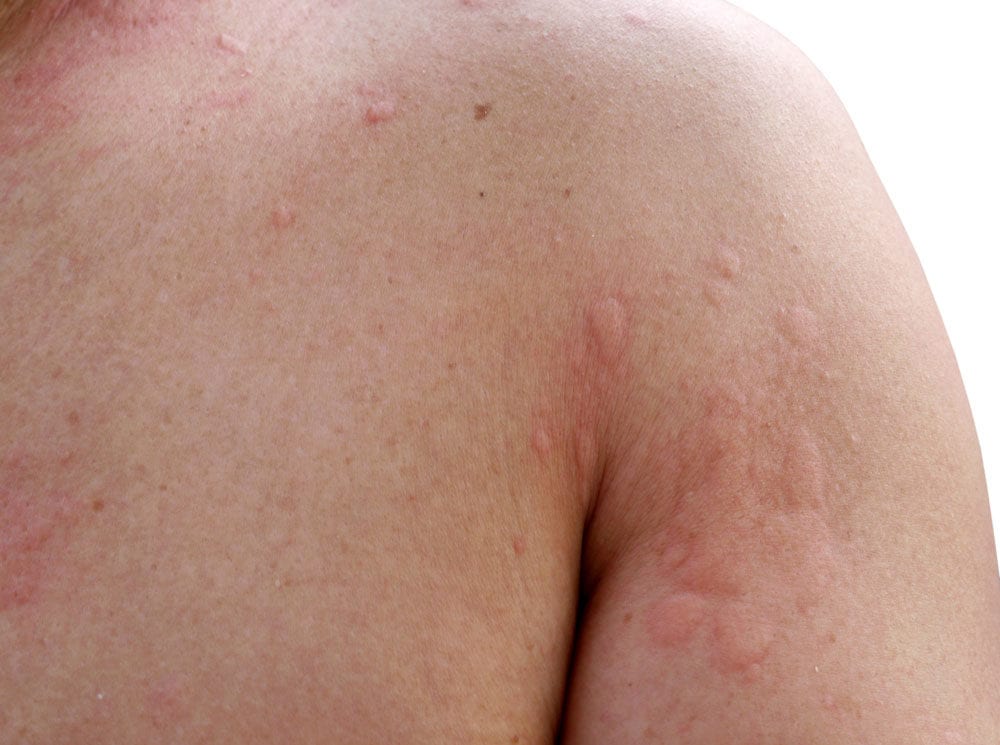 Hives symptoms and treatments