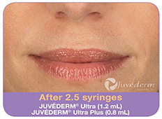 Juvederm Before and After Photos