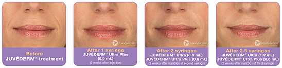 Juvederm Before and After Photos