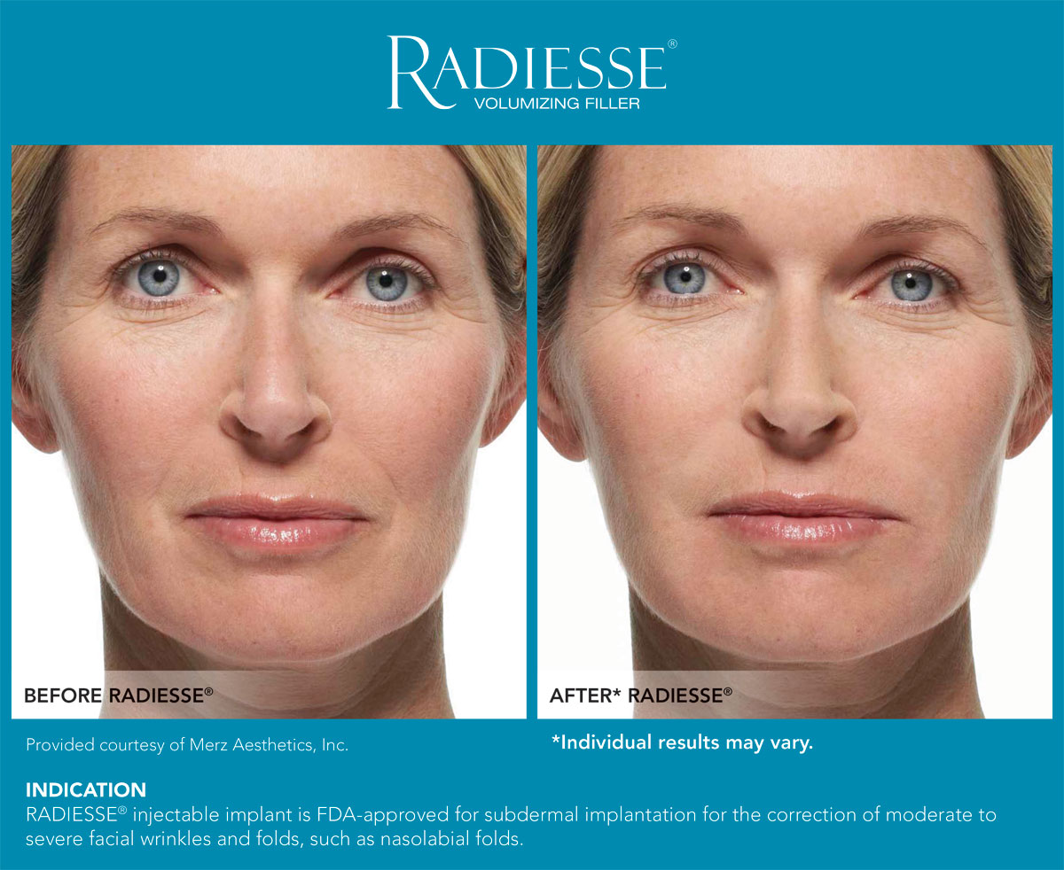 Radiesse Before and After Photos