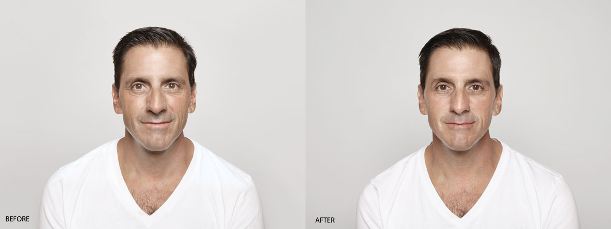Restylane Before and After Photos
