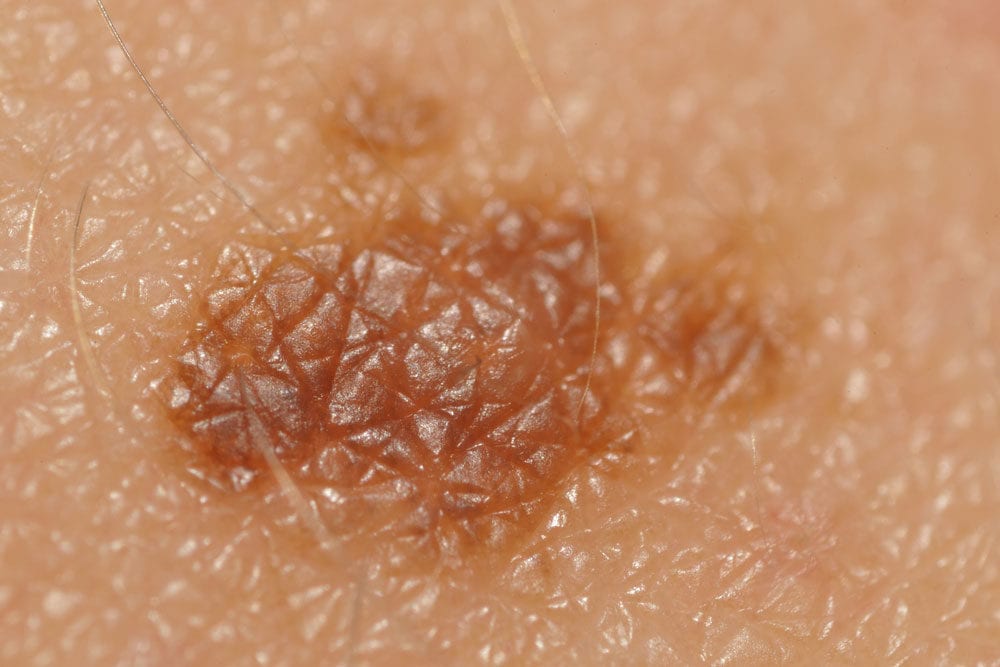 Skin cancer symptoms, diagnosis, and treatments