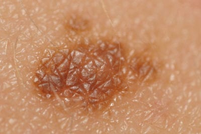 skin-cancer-introduction