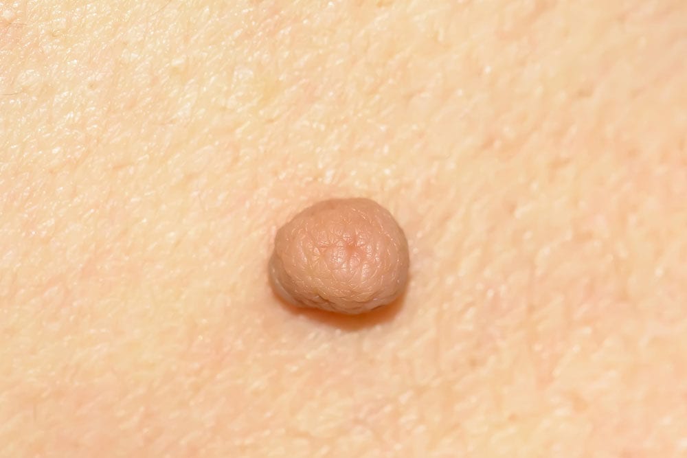 Skin tag treatment and removal