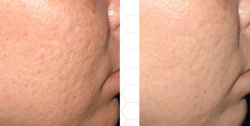 Microneedling Before and After Photos