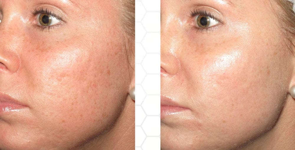 Microneedling Before and After Photos